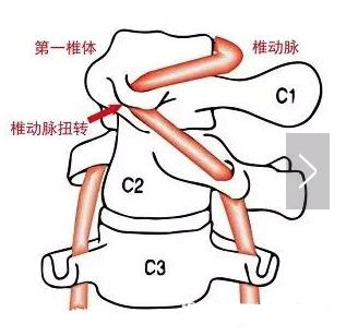 偏頭痛該怎么辦？