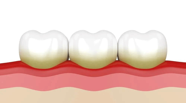 「牙結(jié)石」是怎么毀了一口好牙的？