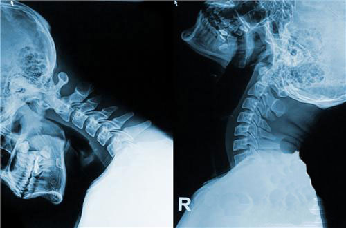頸椎病的癥狀