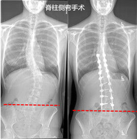 判斷有脊柱側(cè)彎的方法