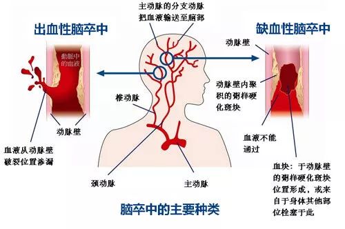 世界卒中日 | 識別卒中早一秒，挽救大腦恢復(fù)好